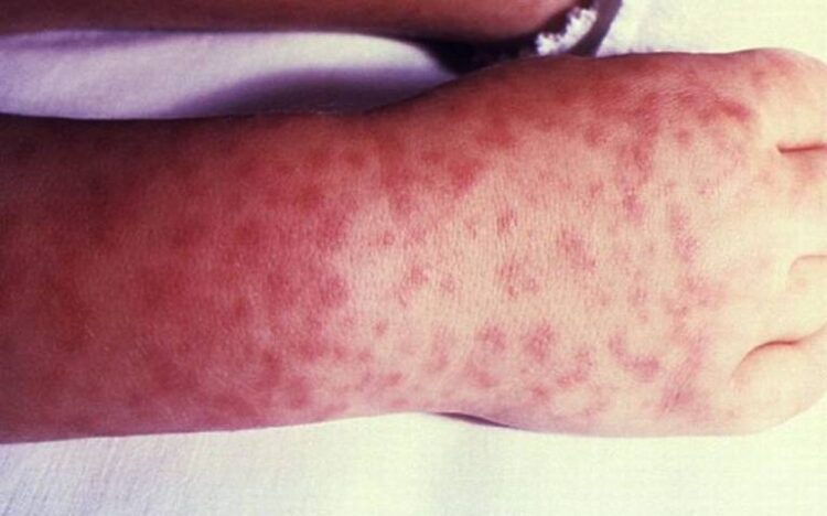 Llama Salud a no discriminar a quienes padecen Lepra