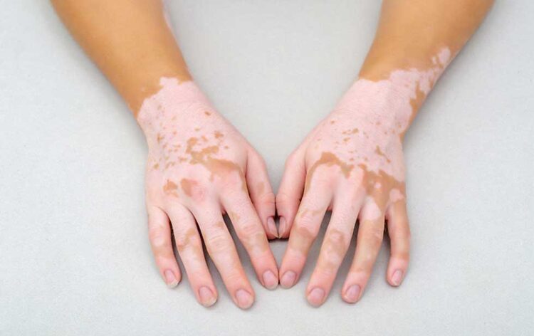 ‘Mal del pinto’ sigue propagándose en Tamaulipas