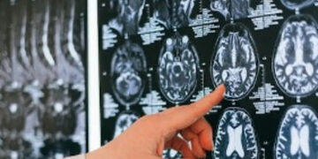 Descubren nueva membrana anatómica que protege al cerebro