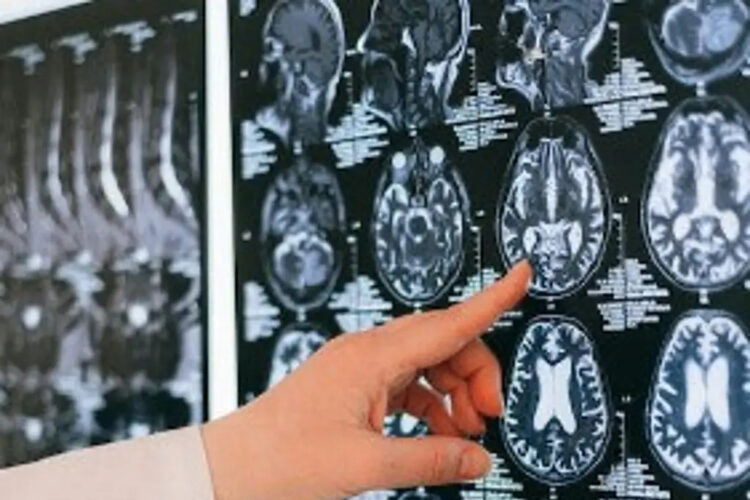 Descubren nueva membrana anatómica que protege al cerebro