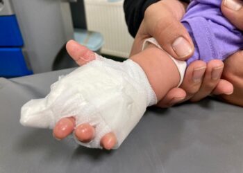 Accidentes por quemaduras afectan más a los niños