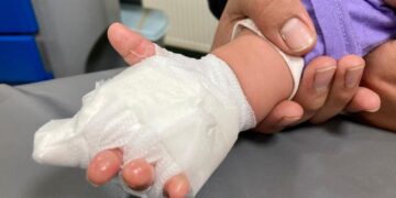 Accidentes por quemaduras afectan más a los niños