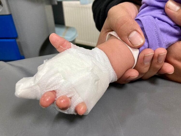 Accidentes por quemaduras afectan más a los niños