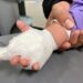Accidentes por quemaduras afectan más a los niños