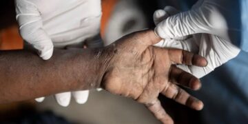África contabiliza casi 38.300 casos y 979 muertes por mpox en 16 países