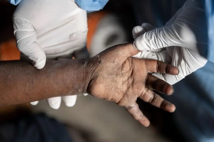 África contabiliza casi 38.300 casos y 979 muertes por mpox en 16 países