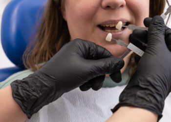 Carillas dentales: La clave para una sonrisa perfecta