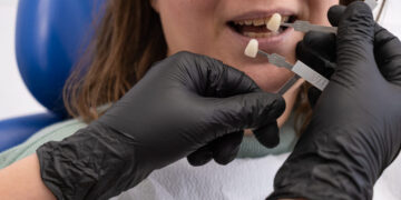 Carillas dentales: La clave para una sonrisa perfecta