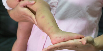 Seis casos de virus Coxsackie reportados en Ciudad Victoria