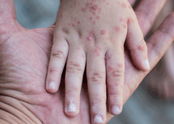 🦠 “Boca-mano-pie”: aumenta contagio en Tamaulipas, pero Salud descarta gravedad