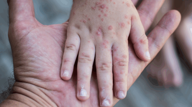 🦠 “Boca-mano-pie”: aumenta contagio en Tamaulipas, pero Salud descarta gravedad