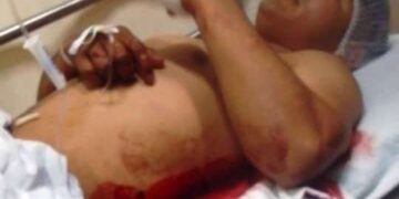 🚨 ¡Lo acuchillaron con un machete! Joven lucha por recuperarse tras brutal ataque