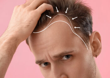 México vs Turquía para el trasplante capilar: ¿cuál es la mejor opción para los pacientes latinoamericanos?