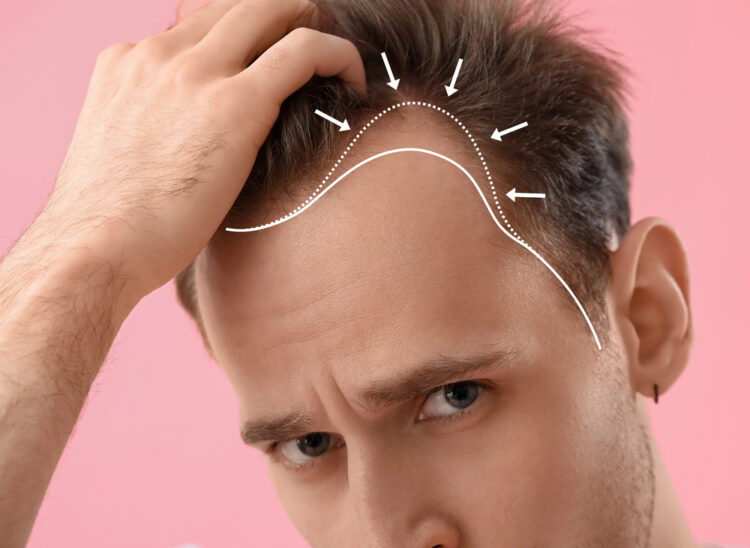 México vs Turquía para el trasplante capilar: ¿cuál es la mejor opción para los pacientes latinoamericanos?